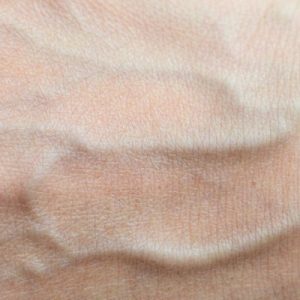 A List of 3 Common Vein Disorders To Know