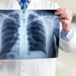 A doctor holding a piece of X-ray film in front of himself, displaying a patient's chest X-ray.
